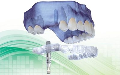 Dental implants crown & bridges
