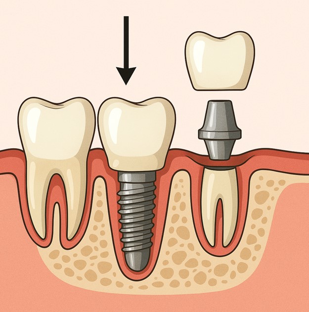 Preparation of Teeth for Crowns or Veneers